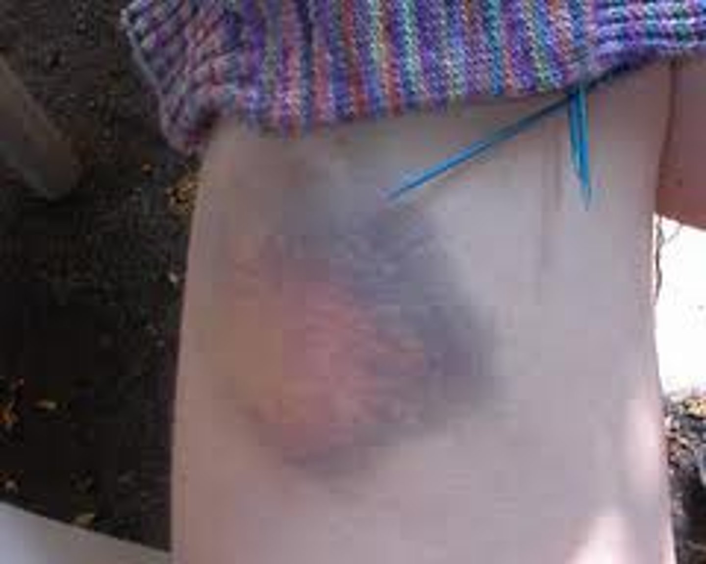 <p>bruise</p>