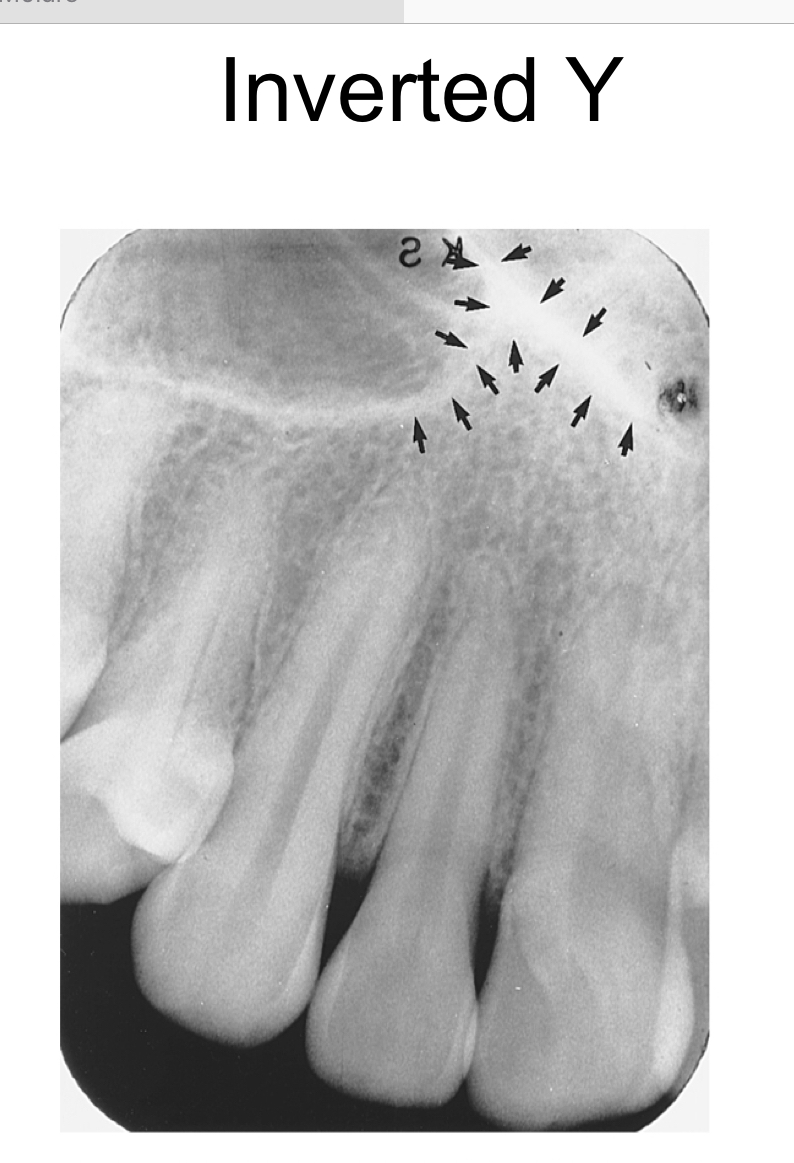 the intersection of the maxillary sinus and the nasal cavity

radiopaque upside down Y