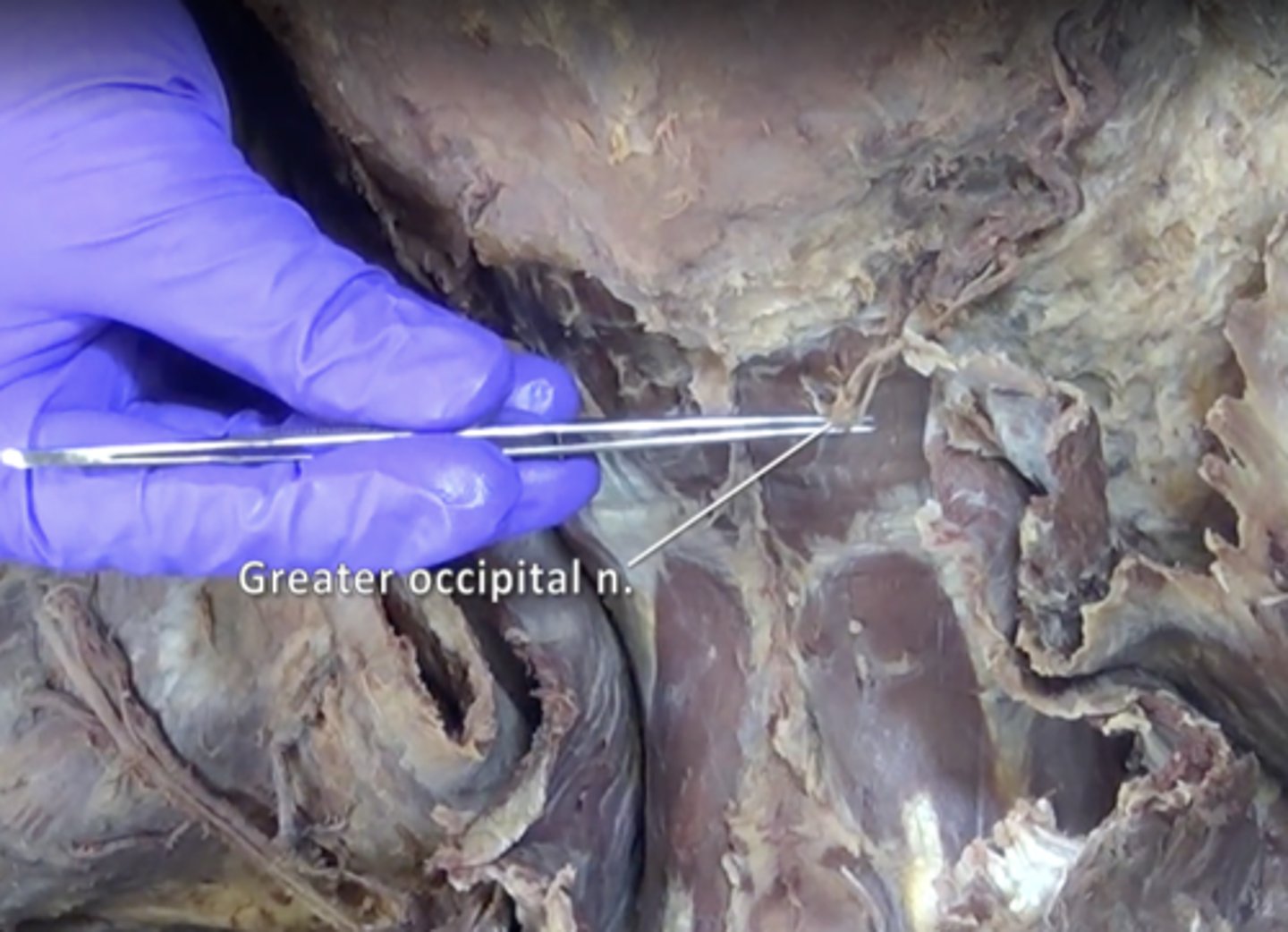 <p>Nerve located in the back of the head and pierces the superior border of the trapezius muscle</p>