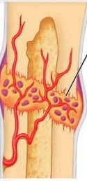 third stage of healing a bone fracture. osteoblasts and osteoclasts migrate into the area and multiply. fibrocartilage callus is replaced by bony callus made of spongy bone.