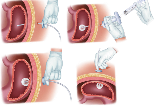 <ul><li><p>Surgical procedure with placement at the stomach</p></li><li><p>Usually reserved for patients already going to OR</p></li><li><p>May be needed if unable to place endoscopically or radiologically</p><ul><li><p>Potentially due to anatomic obstruction</p></li></ul></li></ul><p></p>