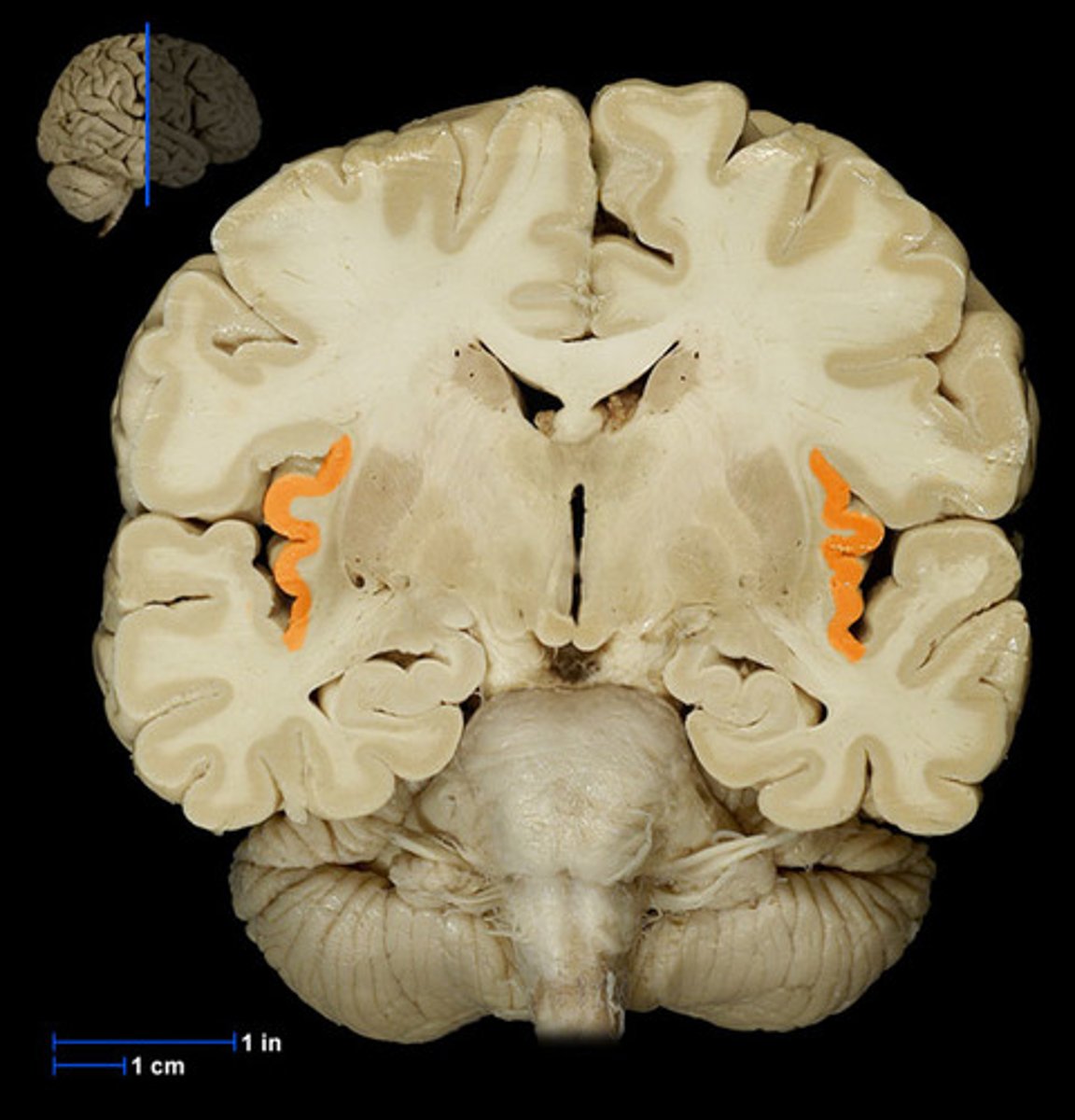<p>located deep within the lateral fissure between the parietal + temporal lobe. perpendicular to lateral fissure.</p>