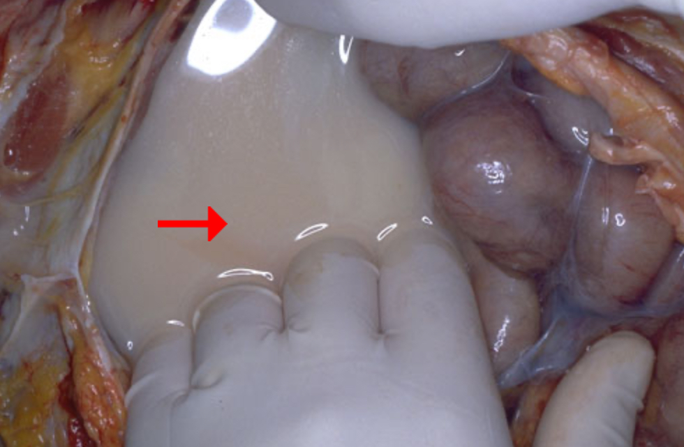 <ol><li><p>Chylous ascites (milky white due to presence of lipids)</p></li><li><p>Blockage of lymphatic drainage</p></li><li><p>Effusion</p></li></ol>