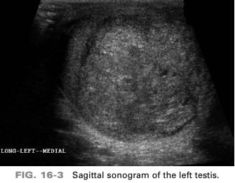 <p>a 35-year-old patient presents with palpable scrotal mass. He is afebrile and denies any scrotal pain. On the basis of this clinical history the sono finding is most suspicious for…</p>