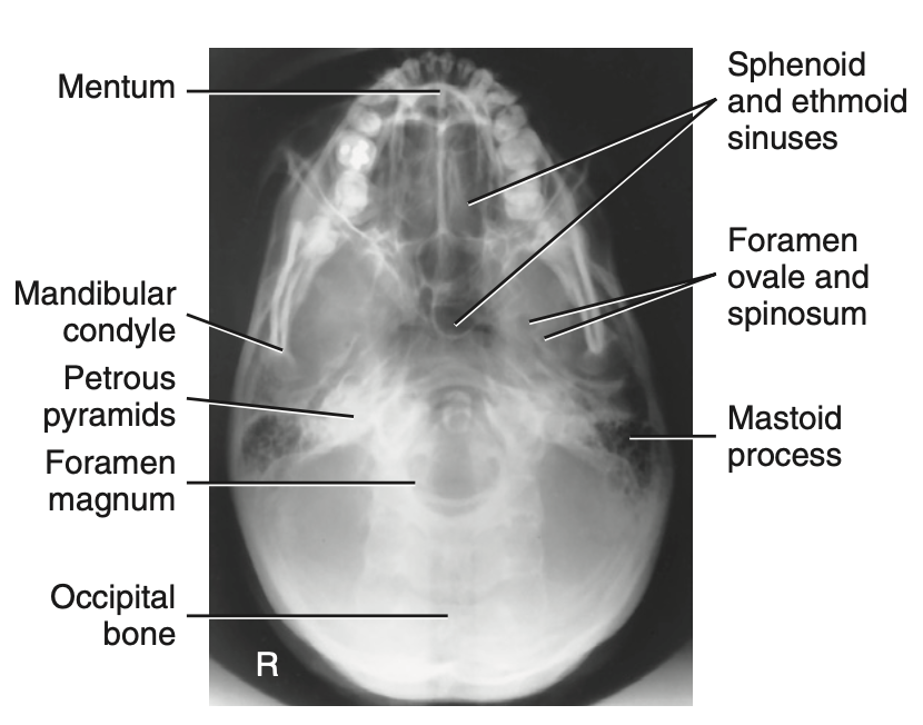 <p>Special: What is <u>best demonstrated</u> for <strong>Submentovertical (SMV) projection </strong>of skull?</p>