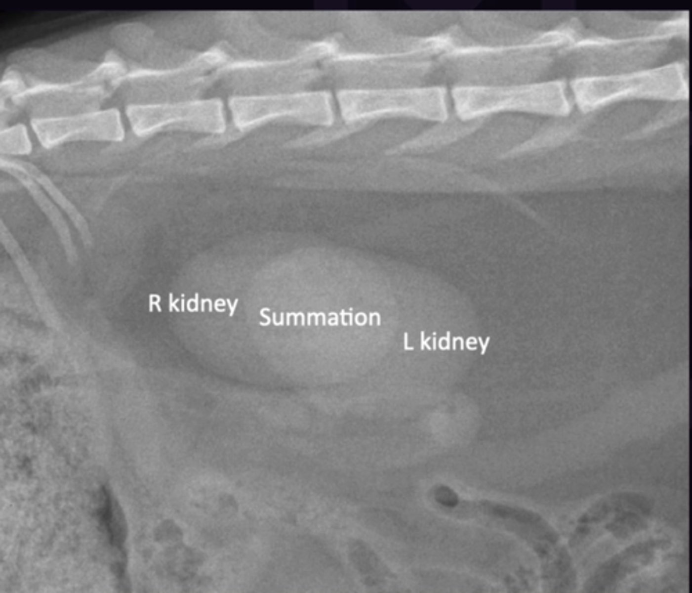 <p>1. Superimposed opacities adding together (Can be tissue or gas). Differs from effacement as separate margins of each kidney can be seen</p><p>2. Superimposition of left + right kidneys, where they are superimposed it is more opaque</p>