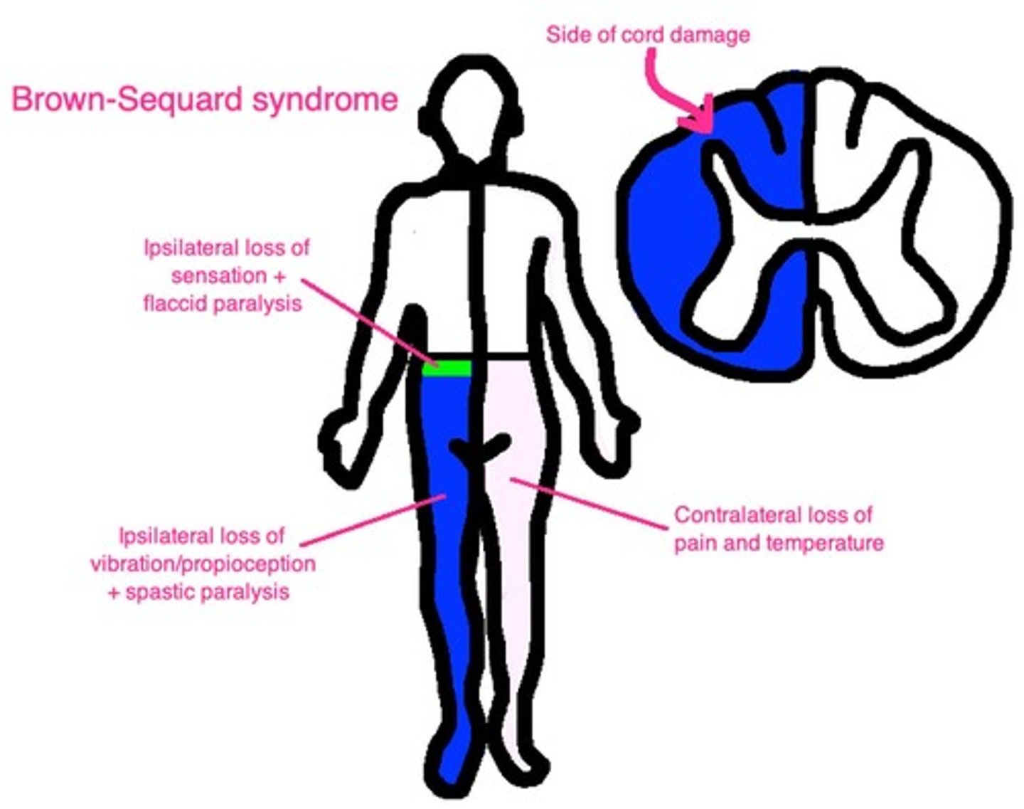 <p>Results in turbulence and stasis, leading to left atrial mural thrombus, which launches off.</p>