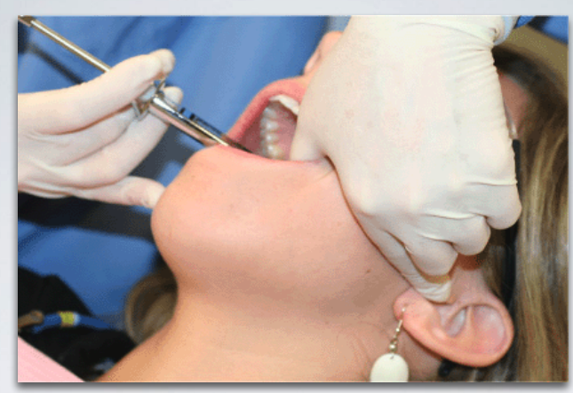 <ol><li><p>thumb palpating anterior border of ramus</p></li><li><p>index finger over intetragic notch of ear</p></li><li><p>advance needle slowly until bone is contacted (neck of condyle)</p></li></ol><p></p>