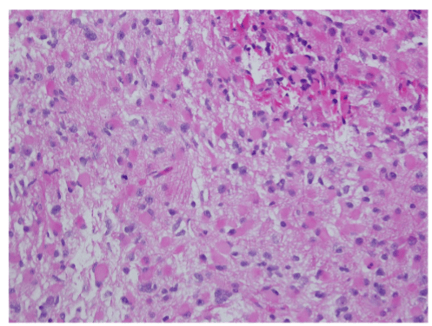 <p>a type of brain tumor that originates from astrocytes, with pleomorphism present</p>