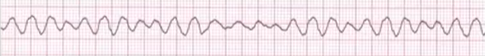<p>COMPLETETLY ABNORMAL; NO PULSE → CPR; from multiple foci</p><ul><li><p>No rate, irregular, no P &amp; PR, wide &amp; irrecognizable QRS</p></li></ul><p></p>