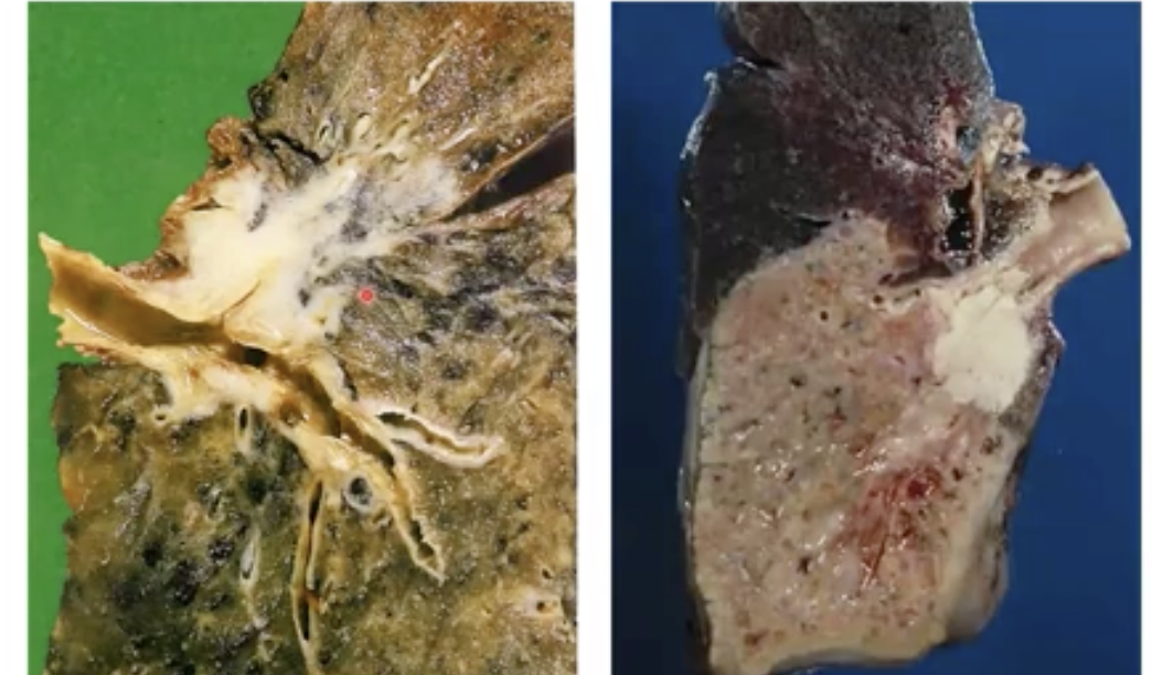 98% of cases are smoker 

Non-small cell carcinoma