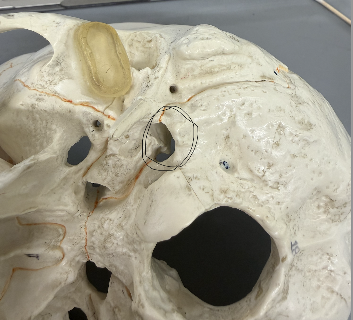 <p>large hole on petrous portion of bone where joins occipital bone; near internal acoustic meatus; passageway for jugular vein; only seen in articulated skull</p>