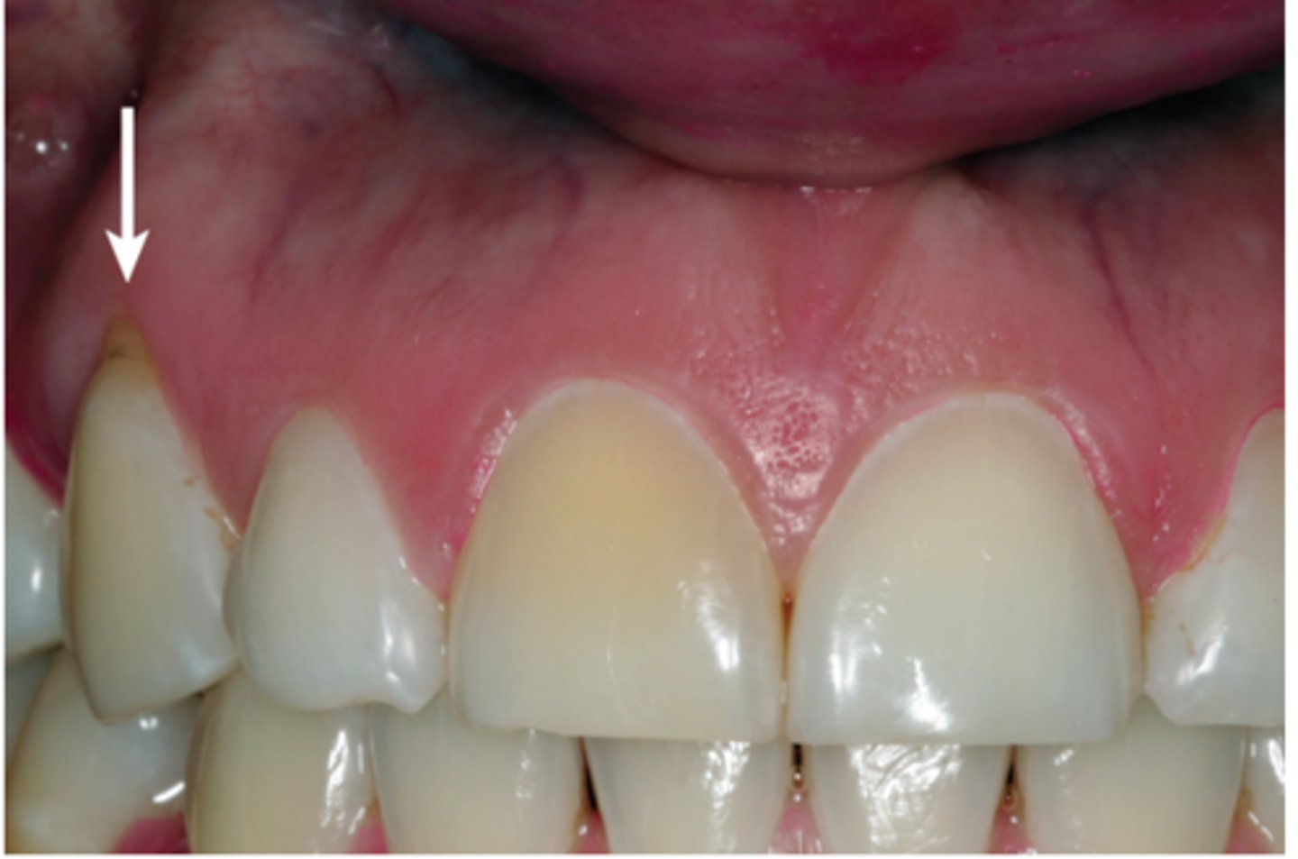 <p>what mucogingival condition is this?</p>