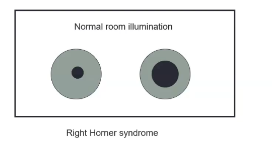 <p>efferent pupil defects: horners</p>
