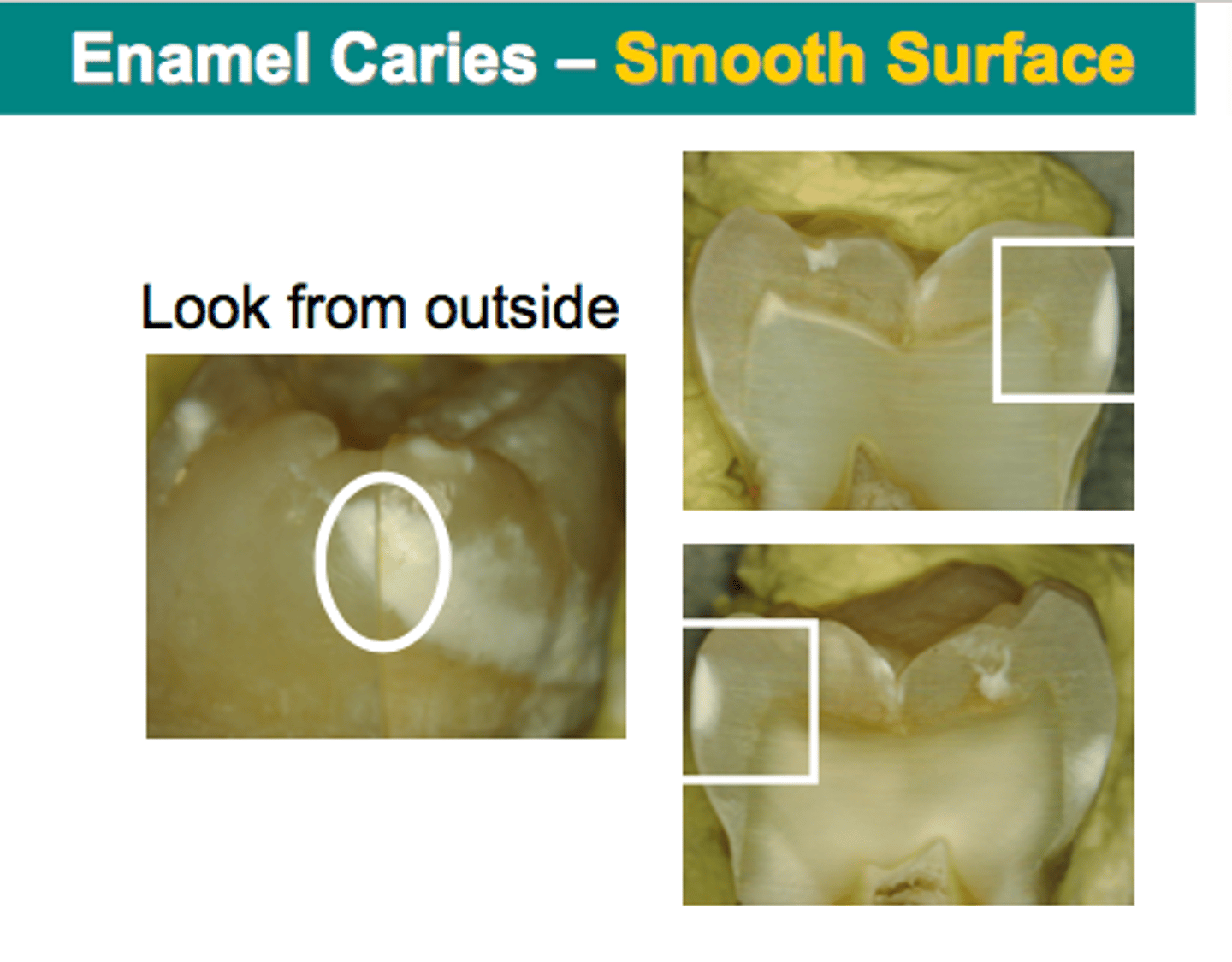 <p>Q: Are these surfaces of teeth with white spots/lesions PRE-CARIOUS?</p><p>A: No, they are CARIOUS</p>
