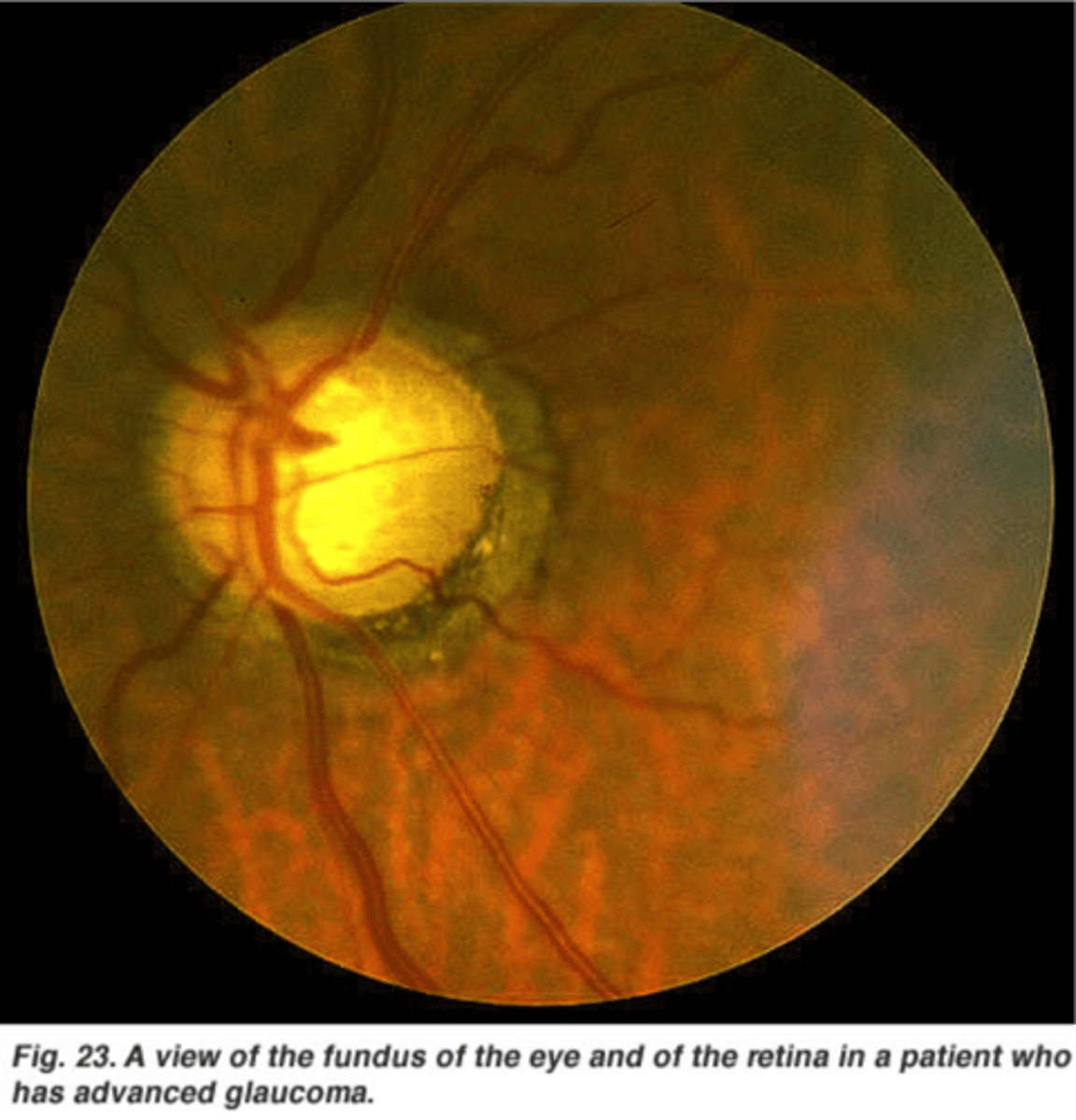 <p>Glaucoma; caused by increased intracranial pressure</p>