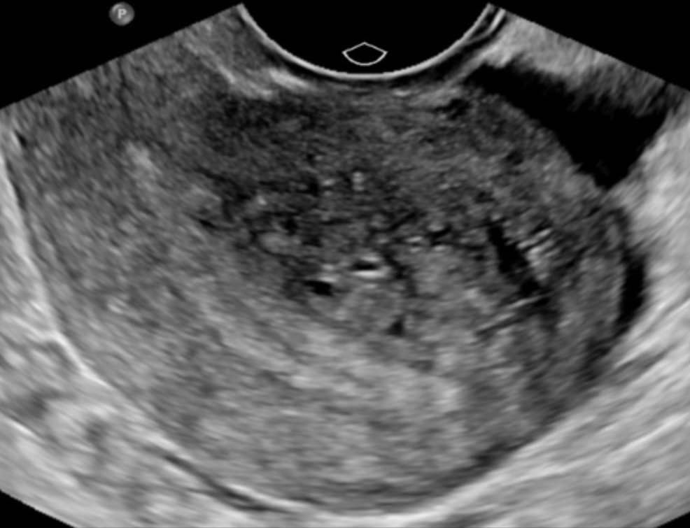 <p>60% of women with adenomyosis experience:</p>