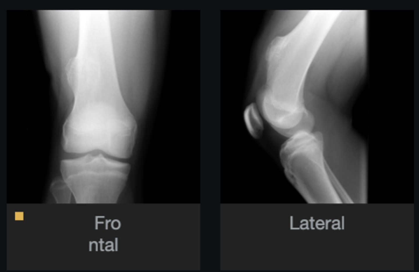 <p>Describe the bone lesion</p>