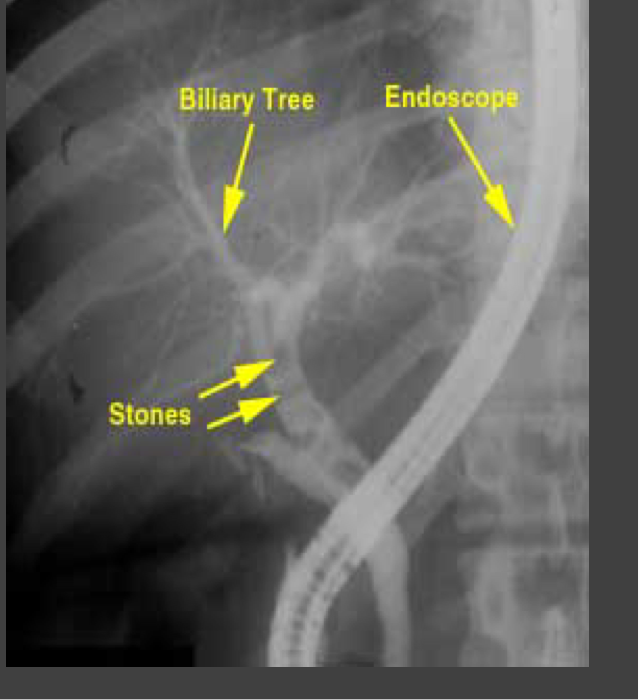 <p>Endoscope is passed into the duodenum and contrast is injected into the bile ducts and/or pancreatic duct</p>