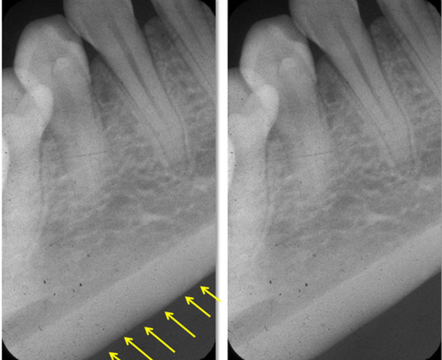 <p>Thick radiopaque band</p>