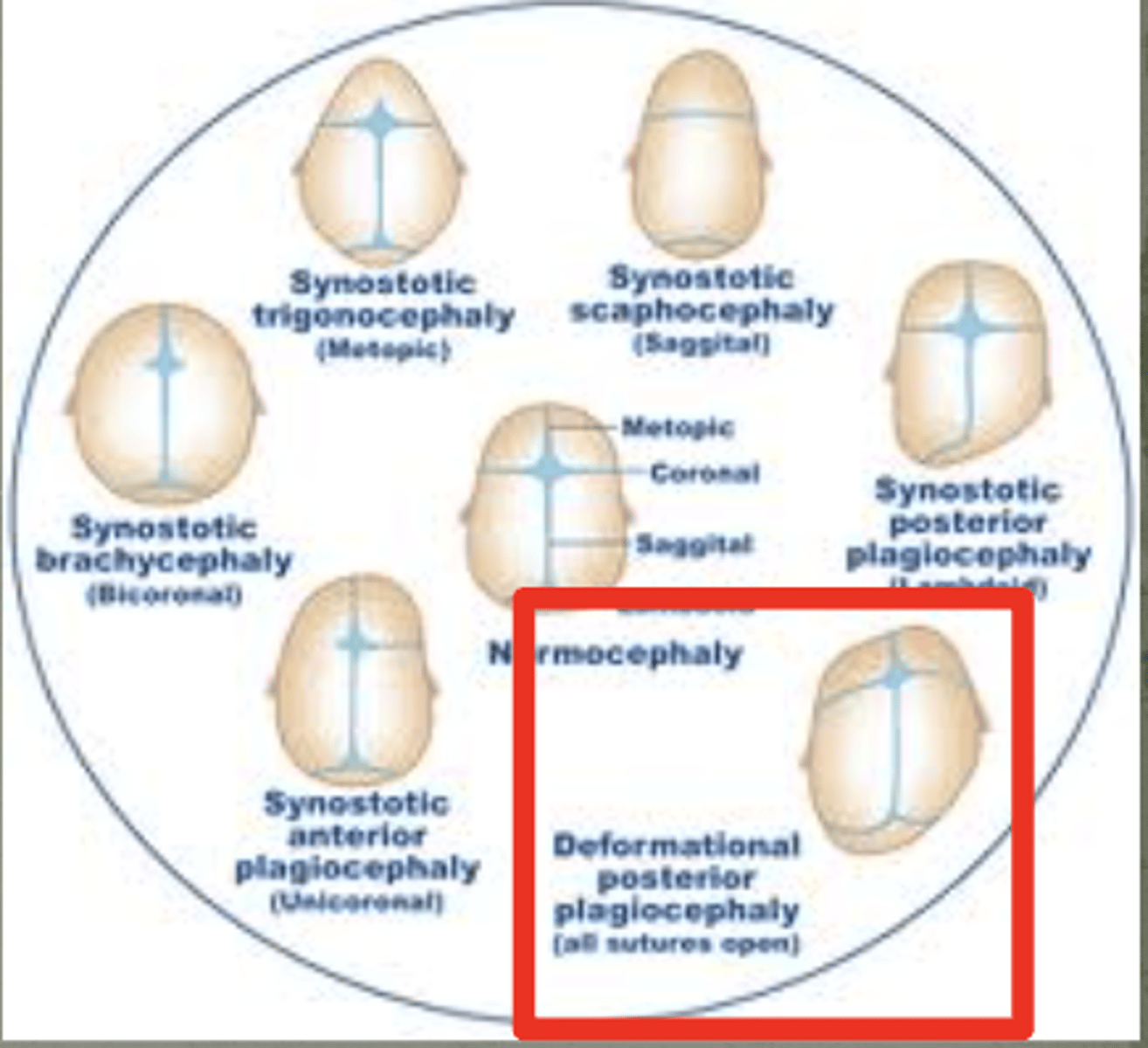 <p>plagiocephaly</p><p>(can correct w helmets)</p><p>an example of defect due to non-disruptive mechanical force (deformation)</p>
