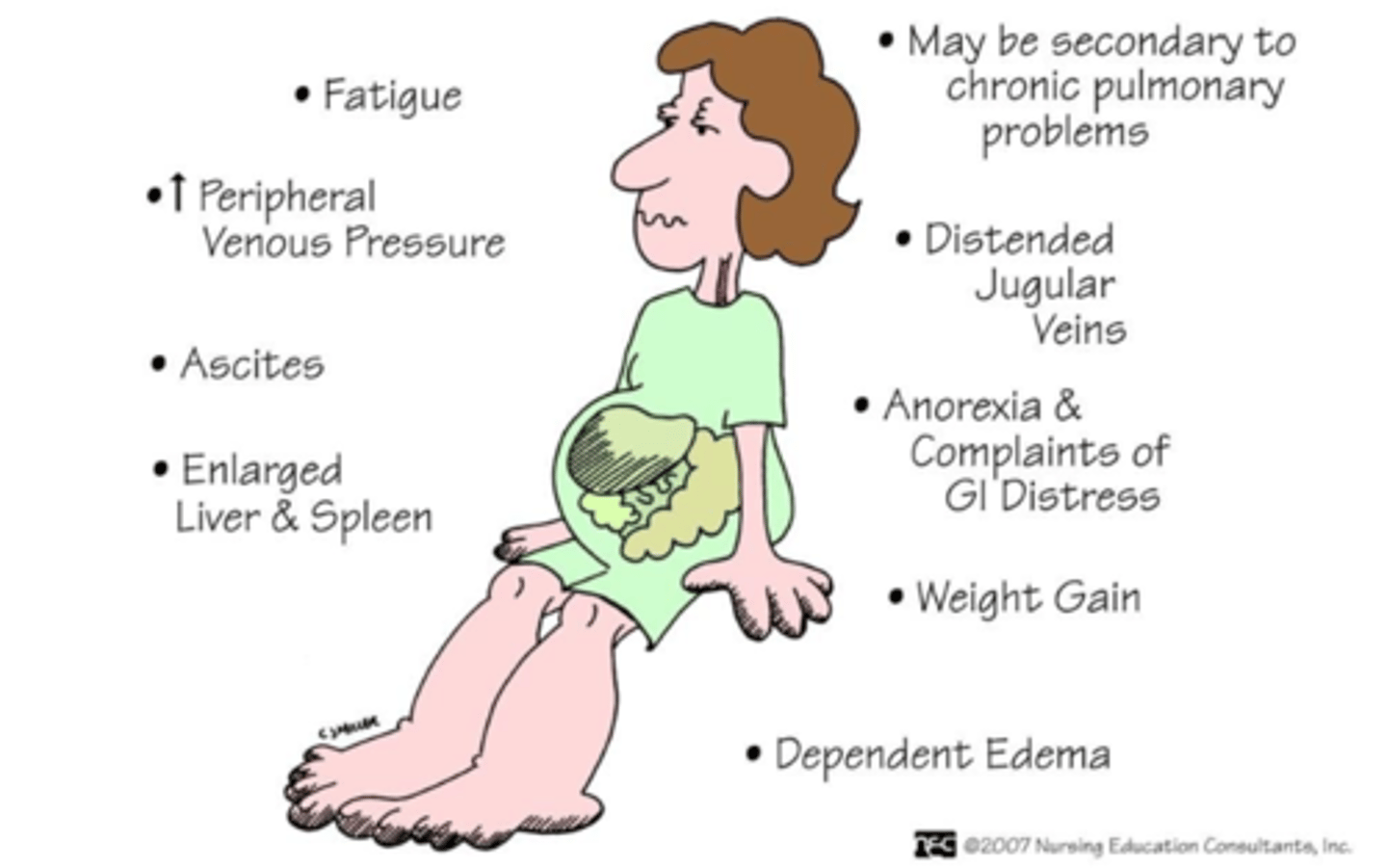 <p>peripheral edema, ascites, hepatomegaly</p>