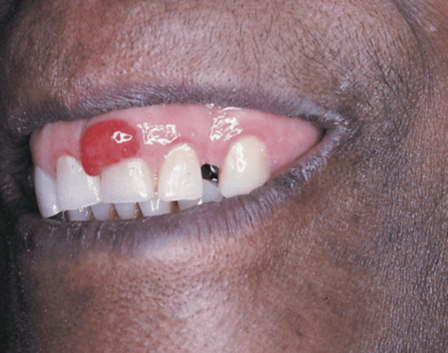 <p>pyogenic granuloma</p>