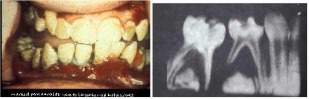 <p><span style="background-color: transparent; font-family: "Times New Roman", serif;">*Children: <strong>5yrs – adolescence</strong></span></p><p style="text-align: justify;"><span style="background-color: transparent; font-family: "Times New Roman", serif;">*<strong>Chronic</strong></span></p><p style="text-align: justify;"><span style="background-color: transparent; font-family: "Times New Roman", serif;">*50% spontaneous remission</span></p><p style="text-align: justify;"><span style="background-color: transparent; font-family: "Times New Roman", serif;">*Skeletal and Extraskeletal lesions</span></p><p style="text-align: justify;"><span style="background-color: transparent; font-family: "Times New Roman", serif;"><strong>*Classic Triad (25%)</strong></span></p><p style="text-align: justify;"><span style="background-color: transparent; font-family: "Times New Roman", serif;"> 1. Single/multiple punched out lesions of skull and/or jaws</span></p><p style="text-align: justify;"><span style="background-color: transparent; font-family: "Times New Roman", serif;"> 2. Uni or Bilateral exopthalmus</span></p><p style="text-align: justify;"><span style="background-color: transparent; font-family: "Times New Roman", serif;"> 3. Diabetes Incipitus</span></p><p></p><p style="text-align: justify;"><span style="background-color: transparent; font-family: "Times New Roman", serif;"><u>ORAL</u>:</span></p><p><span style="background-color: transparent; font-family: "Times New Roman", serif;"><strong>*Lesions: sore mouth, gingival ulcers, halitosis, gingivitis, loose teeth and premature loss, loss of alveolar bone - <u>Mimics advanced periodontal disease</u></strong></span></p>