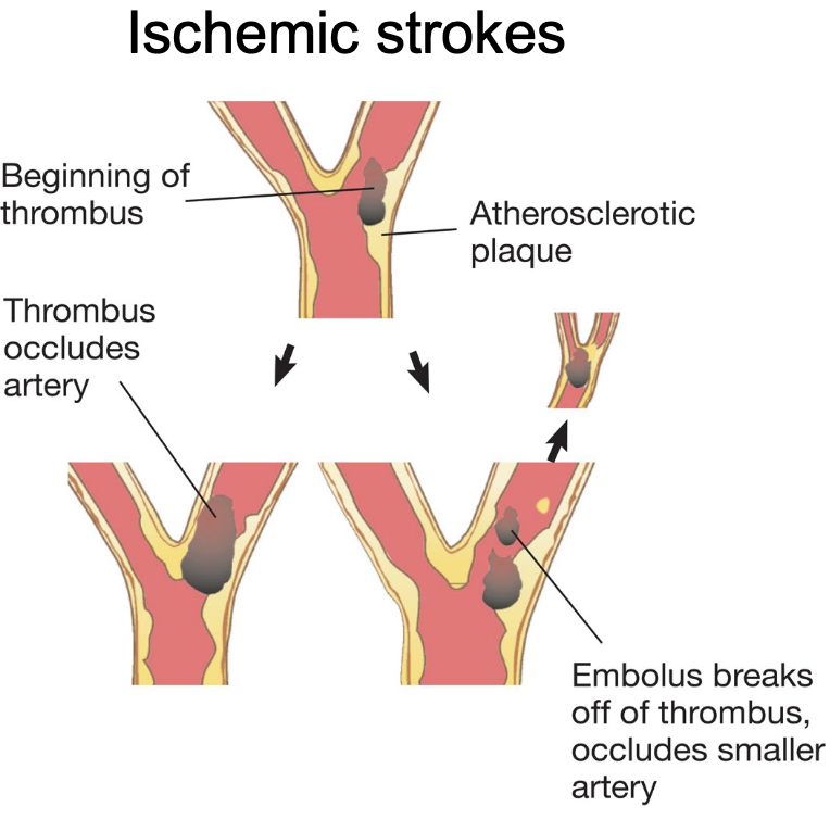 <p>→ blockage of a cerebral blood vessel, resulting in a <strong>stroke</strong></p><ul><li><p>Classifies 87% of all <strong>strokes</strong></p></li></ul><p></p><p><u>Ischemic occlusions (blockages that cause </u><strong><u>strokes</u></strong><u>)</u>:</p><ul><li><p><strong>Thrombus</strong> → blood clot that forms within a blood vessel, reducing flow to an affected area</p><ul><li><p><strong>Embolus</strong> → when a piece of tissue (blood clot/<strong>thrombus</strong>, fat, or bacterial debris) dislodges from its site of origin and occludes a nearby artery</p></li></ul></li></ul><p></p><p><u>Pharmacological remedies</u>:</p><ul><li><p><strong>Thrombolytics</strong> → “clot-busting” drugs that dissolve blood clots to re-establish circulation and hopefully minimize the amount of brain damage</p><ul><li><p>A popular example would be<strong> tissue plasminogen activator (tPA)</strong>, which should be administered within 3-4 hours of a <strong>stroke</strong></p><p></p></li></ul></li></ul><p><u>Technological remedies</u>:</p><ul><li><p><strong>Endovascular embolization</strong> → coils, aspiration devices, and/or strents are thread through the vascular system to reinforce the vessels the site of an occlusion affected</p><ul><li><p>May or may not remove occlusion</p></li><li><p>Access usually through <strong>femoral artery</strong></p></li></ul></li></ul><p></p>