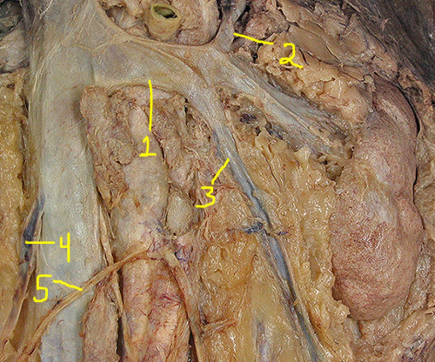 <p>ID 3, assume pt is female</p>