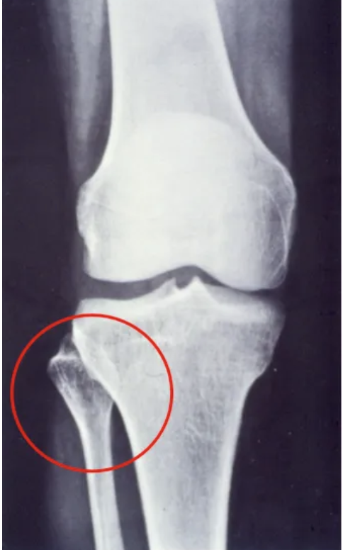 <p>It is a synovial, planar joint that allows slight gliding movement.</p>