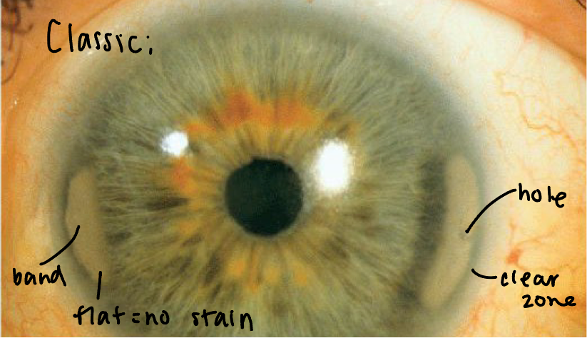<ul><li><p><span><strong>Symptoms</strong>: asymptomatic until advanced disease occurs and then the patient presents w/ irritation (once migrated over visual axis)</span></p></li><li><p><span><strong>Causes</strong>:</span></p><ul><li><p><span><u>Ocular</u>: anterior uveitis, glaucoma, phthisis bulbi, chronic corneal edema and keratitis</span></p></li><li><p><span><u>Age</u>: common in elderly</span></p></li><li><p><span><u>Metabolic</u>: hyperparathyroidism, vitamin D toxicity, sarcoidosis, end stage renal failure</span></p></li></ul></li><li><p><span><strong>Presentation</strong>: <em>calcium</em> salts in Bowman layer, epithelial basement membrane and anterior stroma; starts nasal &amp; temporal</span></p><ul><li><p><span><em>Clear zone</em> between deposits and limbus</span></p></li><li><p><span>Will have <em>transparent holes</em> within deposits</span></p></li><li><p><span>Gradual extension to central cornea</span></p></li><li><p><span>Advanced lesions become nodular and elevated = neg stain</span></p></li></ul></li><li><p><span><strong>Treatment</strong>: chelation</span></p><ul><li><p><span>Removal of the epithelium and calcium then EDTA is applied until calcium is removed</span></p></li></ul></li></ul><p></p>