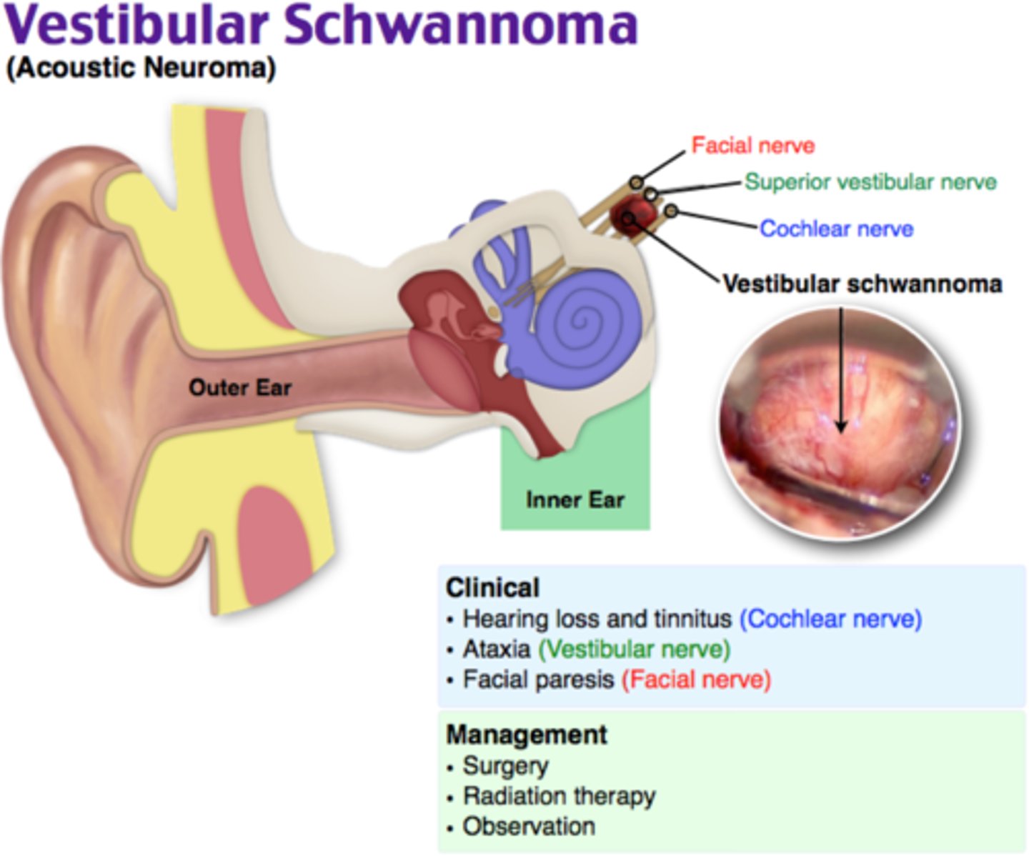 <p>Benign, slow-growing tumor of nerve sheath (schwan cells) of acoustic nerve.</p><p>Thery account for 90% of cerebellopointine angle tumours</p>