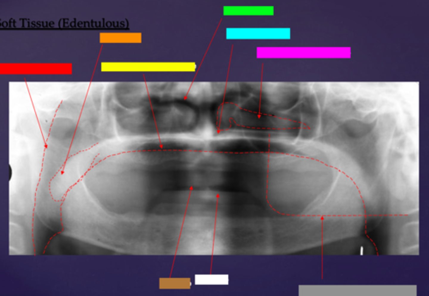 <p>ID the soft tissue anatomy indicated by the arrow pointing from the white box:</p>