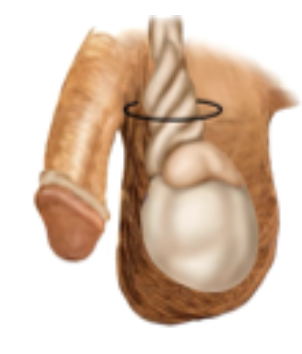 <p>The spermatic cord is coiled</p>