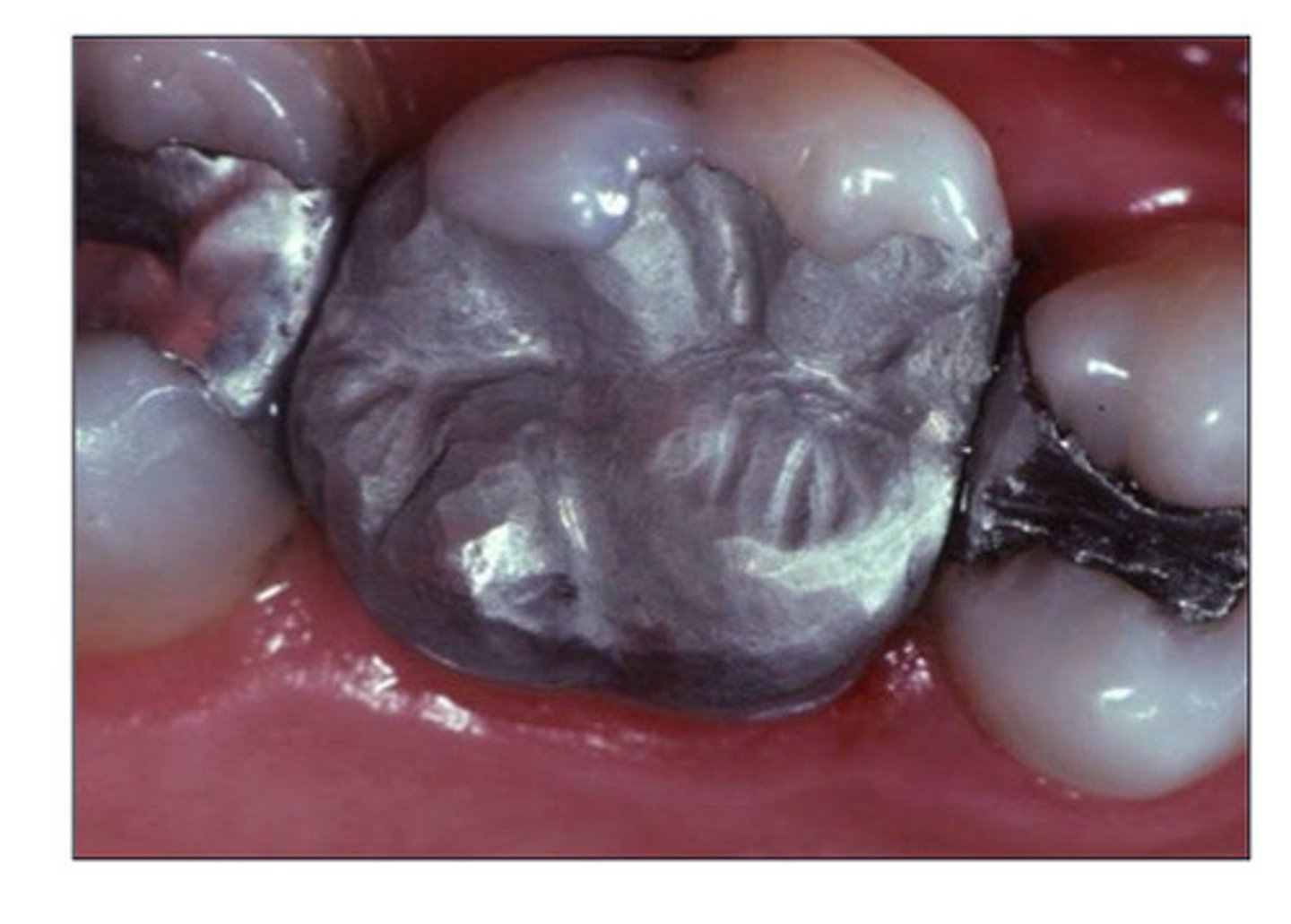 <p>- drives out trapped air</p><p>- adapt closely to prep wall</p><p>- press out excess mercury</p><p>- can help create tooth form</p>
