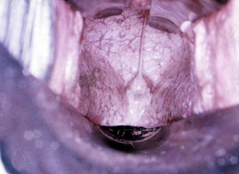 <p>Fill in the blank: A vaginal examination looks at the cervix, it changes in response to the steroid hormone status of the mare</p>
<p>Note: It becomes very tightly puckered when pregnant</p>