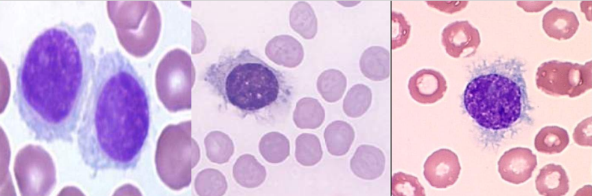 <p>A. Identify the abnormality / cell</p><p>B. This is seen in what condition / disease</p>