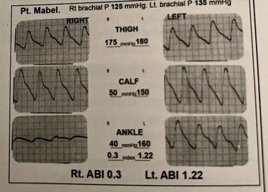 <p>A 3-cuff PVR and pressure study was performed on this diabetic patient. Normal pulses were palpated to the popliteal levels, no pulses were detected on the right PTA or DPA. What is the disease level on the right?</p>