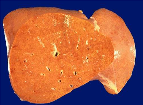 <p><span><span>The image depicts a liver with fatty change, which is the result of inadequate apoprotein production (the enzyme needed to transport lipid out of cells) as a result of cell injury and damage to the rough endoplasmic reticulum. A way to confirm that this liver is affected by fatty change is:</span></span></p><p>Place in formalin and if it floats, this confirms fatty change</p><p>&nbsp;</p><p>Place in formalin and if it sinks, this confirms fatty change</p><p>&nbsp;</p><p>No need to do anything – nothing else can make a liver look this enlarged or pale yellow/orange.</p>