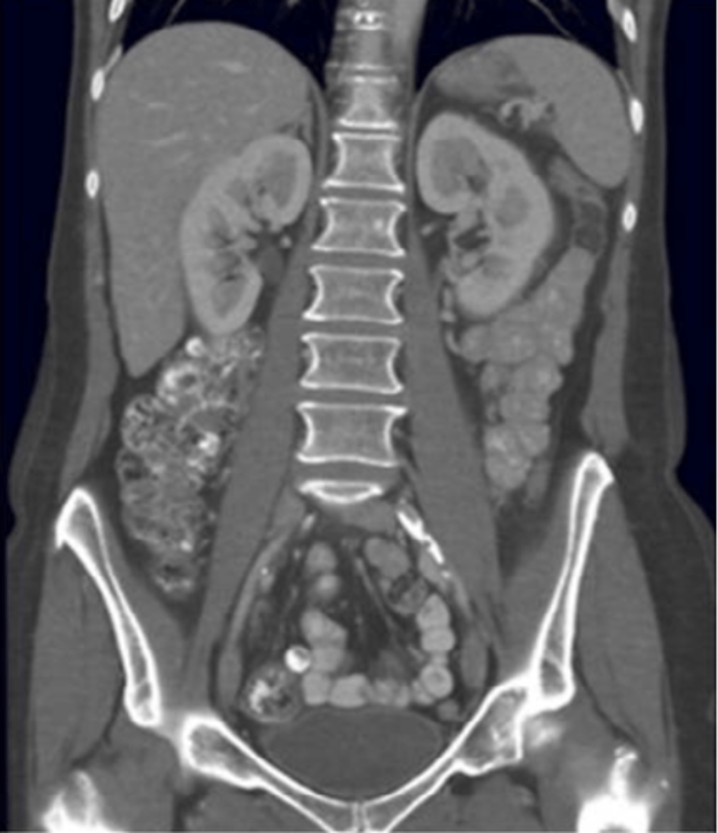 <p>The kidneys are located behind the peritoneal lining of the abdominal cavity.</p>