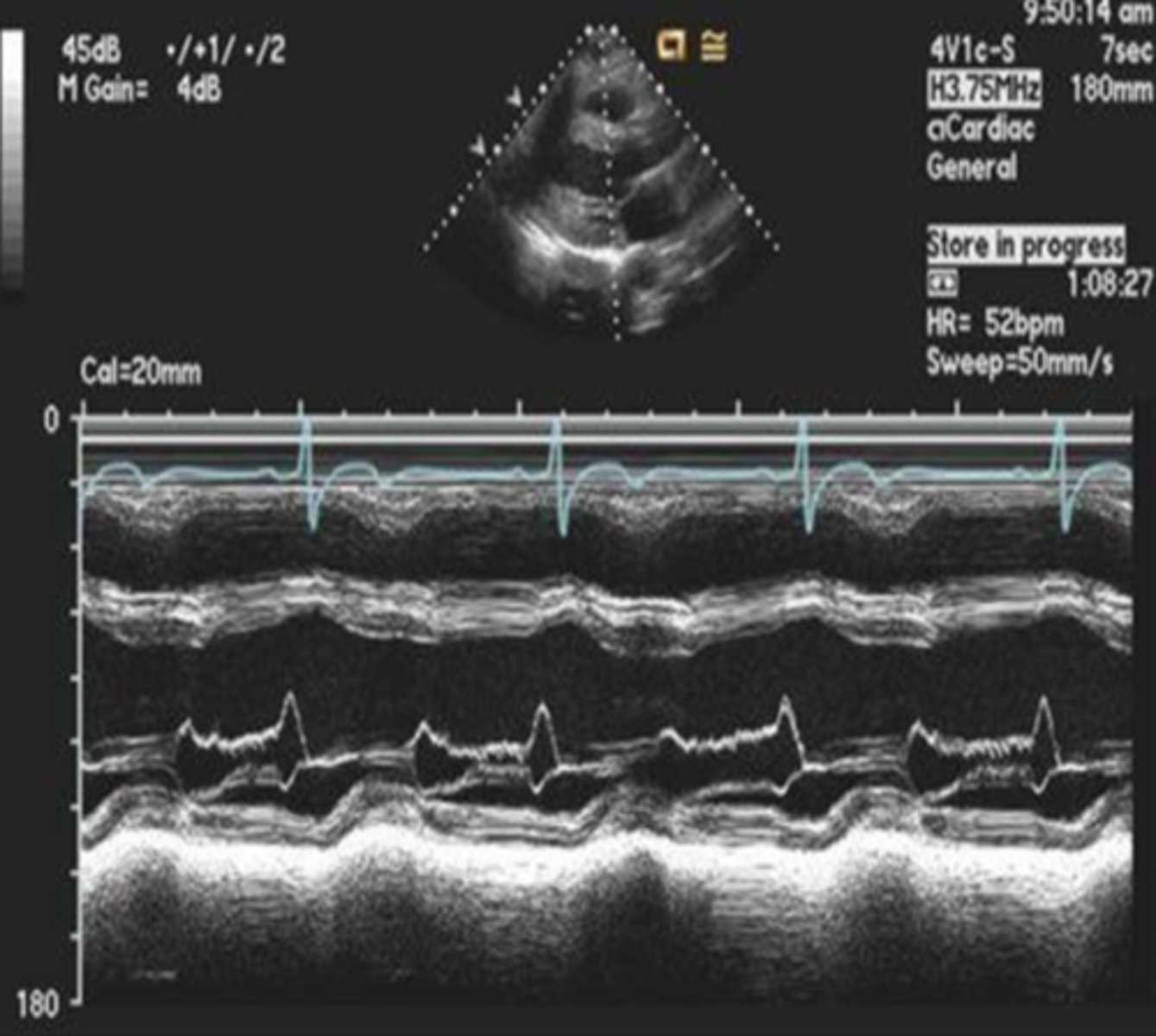 <p>diastolic flutter of the AML with aortic regurgitation</p>