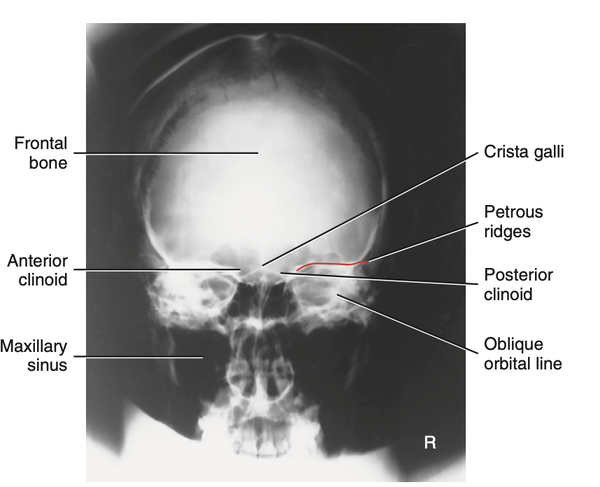 <p>How do you <u>critique</u> radiograph of <strong>PA projection (</strong><span style="color: rgb(255, 0, 0)"><strong>0 degrees</strong></span><strong>) </strong>method for <strong>skull</strong>?</p>