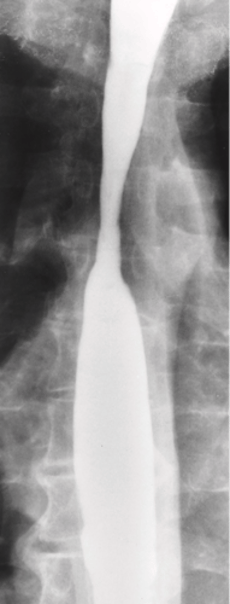 <p>What is Barrett Esophagus</p>
