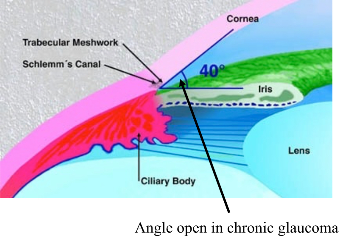 <ul><li><p>primary open angle is slow and progressive. When the trabecular mesh work is gradually blocked. The angle between iris and cornea remain the same. </p></li><li><p>Primary closed angle is when the agile between the cornea and iris is reduced. So fluid cannot pass through canal of schlemm . More painful and vision loss. </p></li></ul>