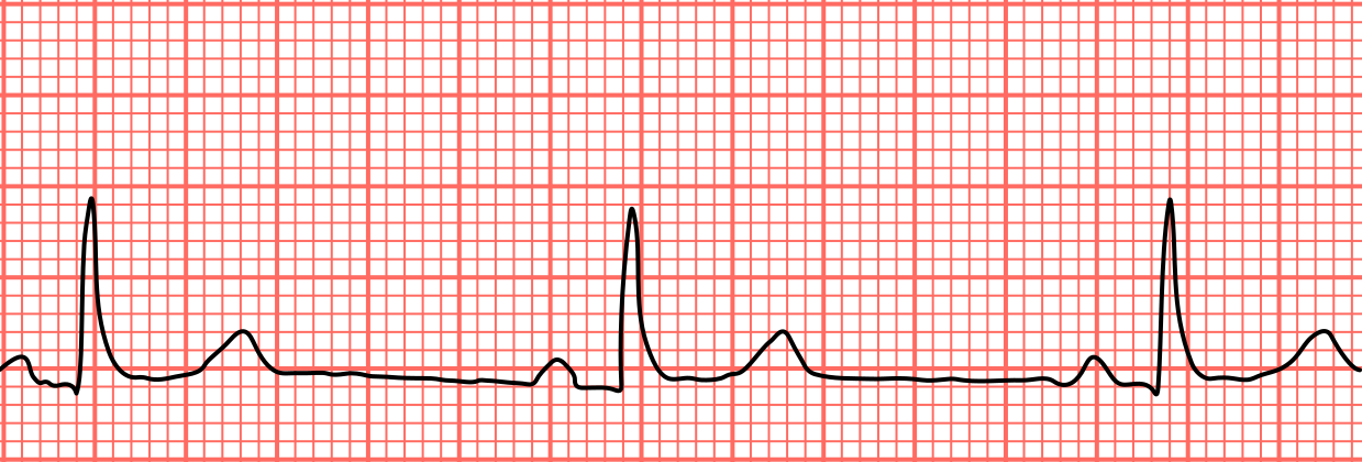 <p>sinus bradycardia </p>