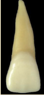 <p><mark data-color="blue" style="background-color: blue; color: inherit">maxillary central incisors #8 and #9; contacts</mark></p>