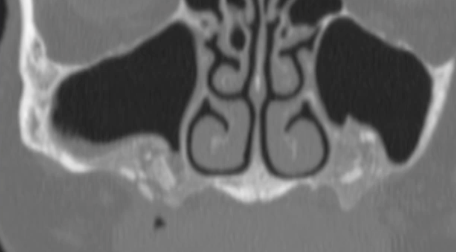 <p>what could be the cause of this uniform elevation of the sinus floor </p>