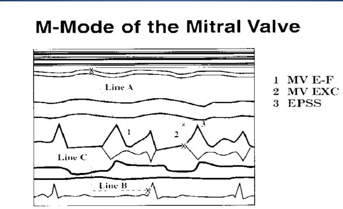 <p>1. MV E-F</p><p>2. MV EXC</p><p>3. EPSS</p>