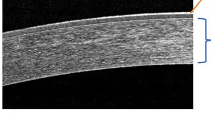<p>corneal stroma </p>